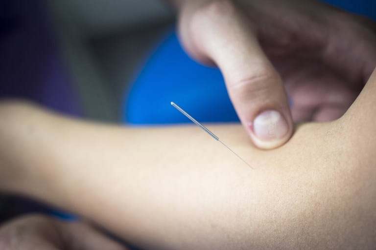 Acupuncture treatment for tennis elbow